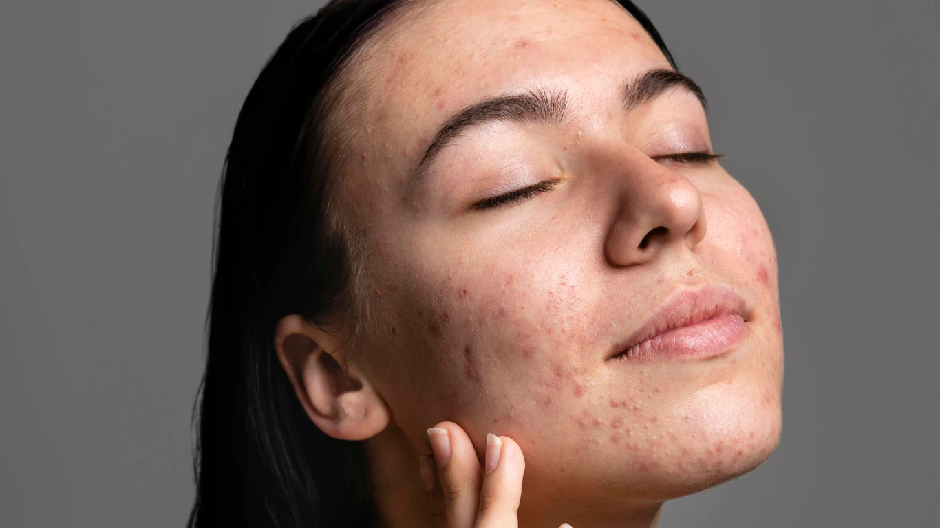 Dry-Skin-but-Breaking-Out-Heres-Why-How-to-Fix-It
